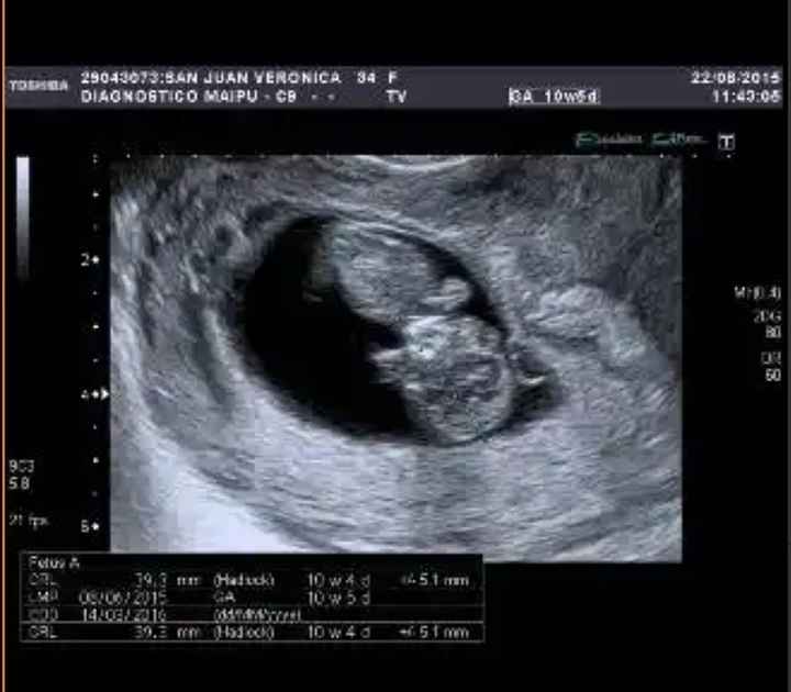 Ayuda con método ramzi: niño o niña? - 1