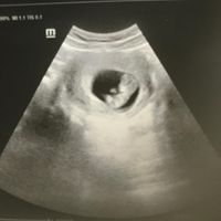 Ayuda con método ramzi: niño o niña? - 1