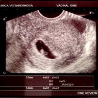 Ayuda con método ramzi: niño o niña? - 1
