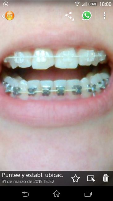 ¿alguna se ha casado con brakets? - 1