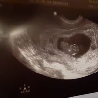 Ayuda con método ramzi: niño o niña? - 1
