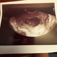 Ayuda con método ramzi: niño o niña? - 1