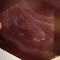 Ayuda con método ramzi: niño o niña? - 2