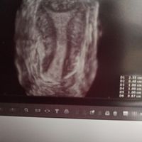 Proceso tratamiento fiv - 1