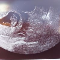 Ayuda con método ramzi: niño o niña? - 1