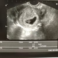 Ayuda con método ramzi: niño o niña? - 1