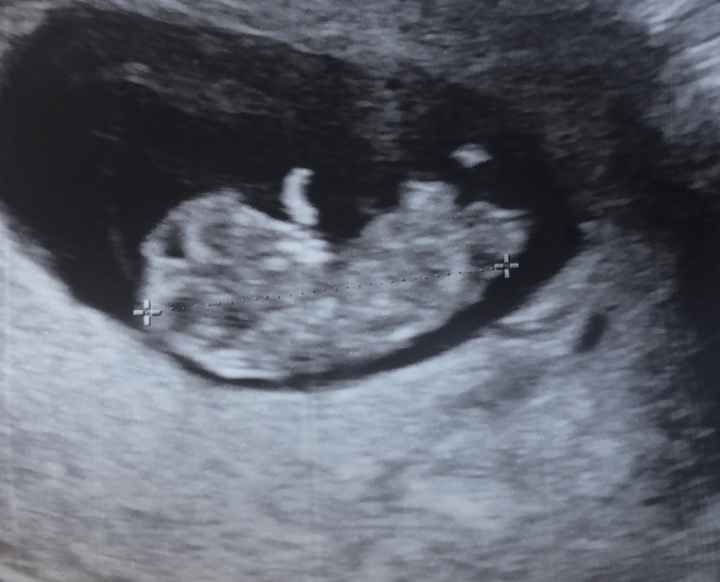 Ayuda con método ramzi: niño o niña? 5