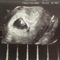 Ayuda con método ramzi: niño o niña? - 1