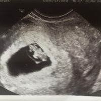Ayuda con método ramzi: niño o niña? - 1