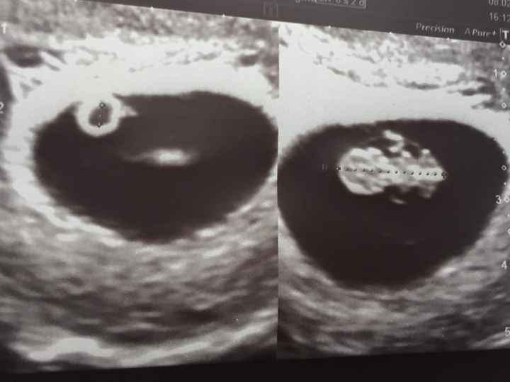 eco vaginal 8+2