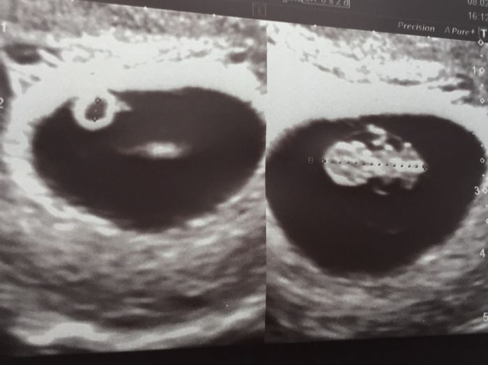 eco vaginal 8+2
