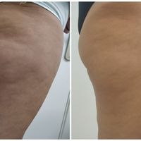 Criolipolisis - 1