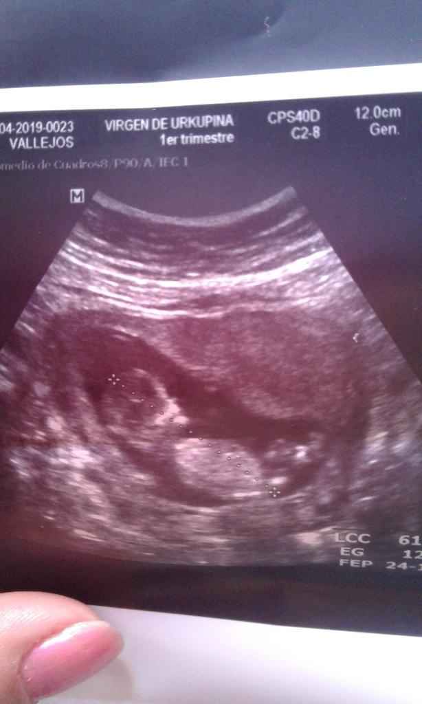Tubérculo genital: niña 19