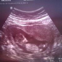 Tubérculo genital: niña - 1