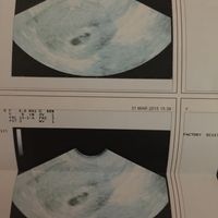 Buscadoras después de uno o varios abortos  - 1