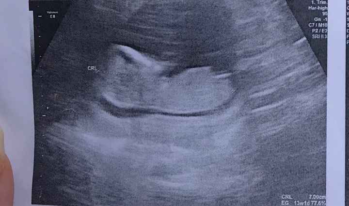 Tubérculo genital - 1