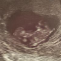 Ayuda con método ramzi: niño o niña? - 1