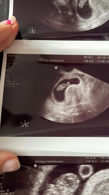 Ayuda con método ramzi: niño o niña? - 1