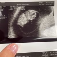 Ayuda con método ramzi: niño o niña? - 1