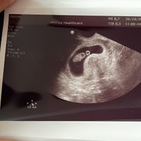 Ayuda con método ramzi: niño o niña? - 1