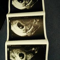 Ayuda con método ramzi: niño o niña? - 1