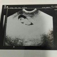 Ayuda con método ramzi: niño o niña? - 1