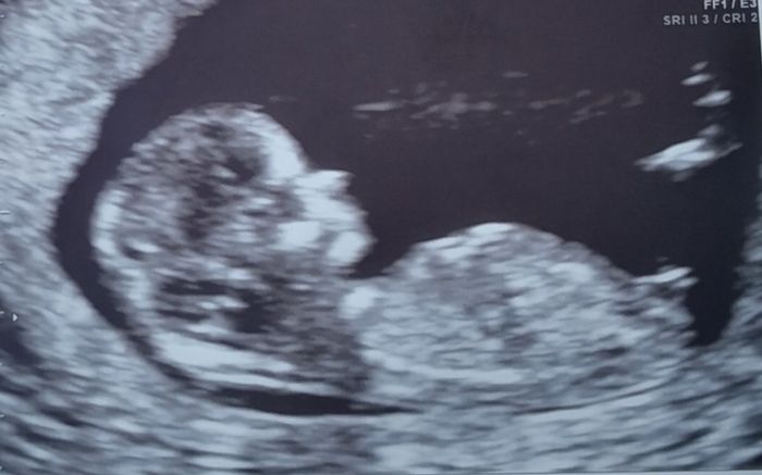 Tubérculo genital: niña - 1