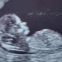 Tubérculo genital: niña - 1