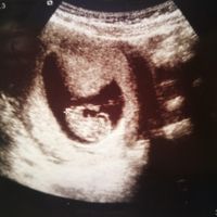 9+3 semanas (2,3 cm)