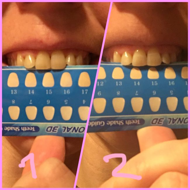  Blanqueo dental 2.0 con tiras - 3