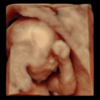 Buscadoras después de uno o varios abortos iii - 1