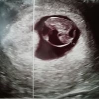 Ayuda con método ramzi: niño o niña? - 1