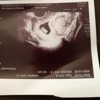 Ayuda con método ramzi: niño o niña? - 1