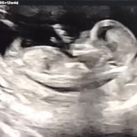 Ayuda con método ramzi: niño o niña? - 1