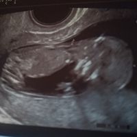 Ayuda con método ramzi: niño o niña? - 1