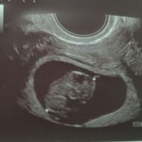 Ayuda con método ramzi: niño o niña? - 1