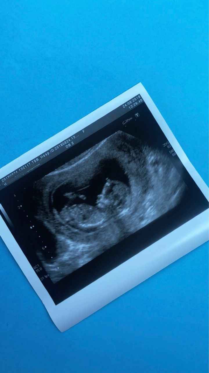 Ayuda con método ramzi: niño o niña? - 2
