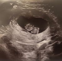 Ayuda con método ramzi: niño o niña? - 2
