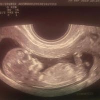 Ayuda con método ramzi: niño o niña? - 1