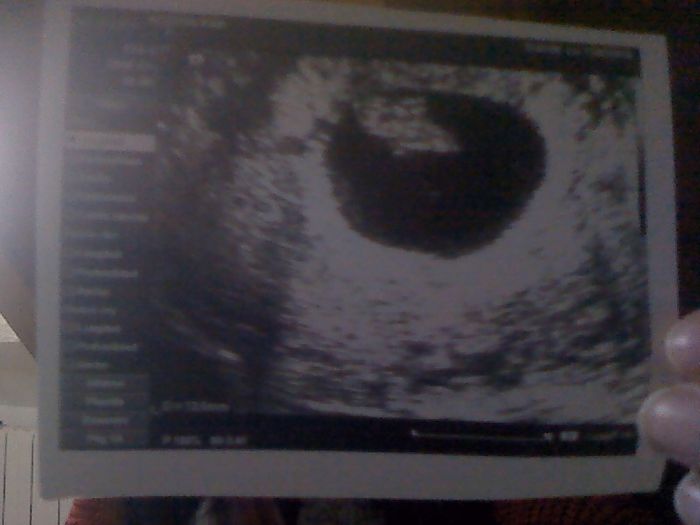eco vaginal 8 semanas