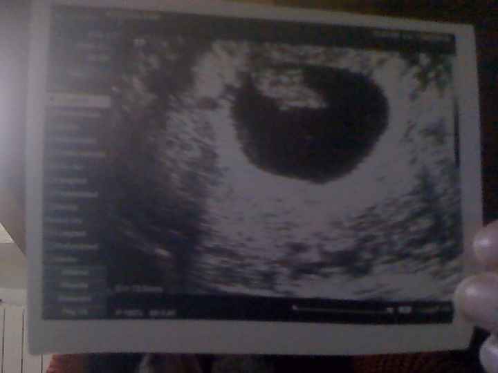 eco vaginal 8 semanas