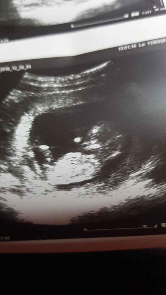 Ayuda con método ramzi: niño o niña? - 1