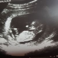 Ayuda con método ramzi: niño o niña? - 1