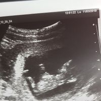 Ayuda con método ramzi: niño o niña? - 2