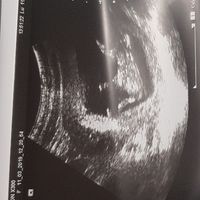 Ayuda con método ramzi: niño o niña? - 2