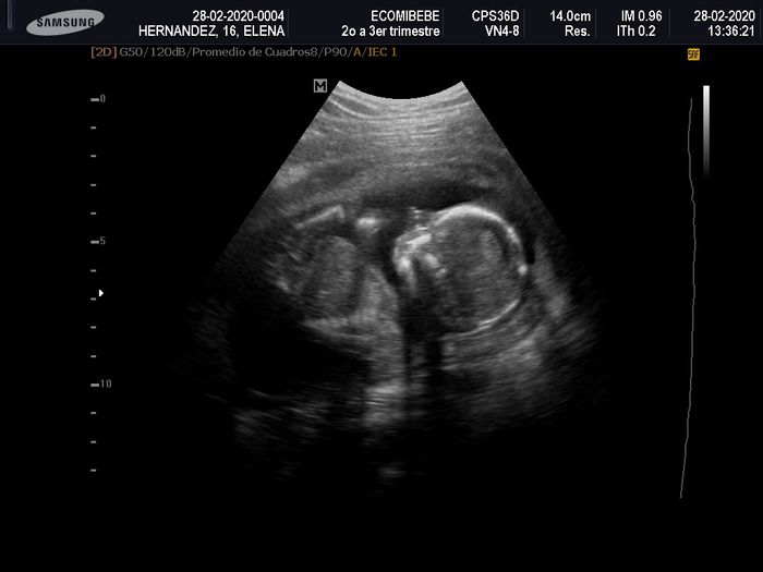 Ayuda con método ramzi: niño o niña? - 1