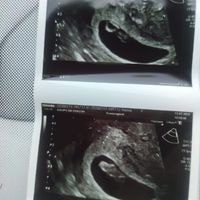 Ayuda con método ramzi: niño o niña? - 1