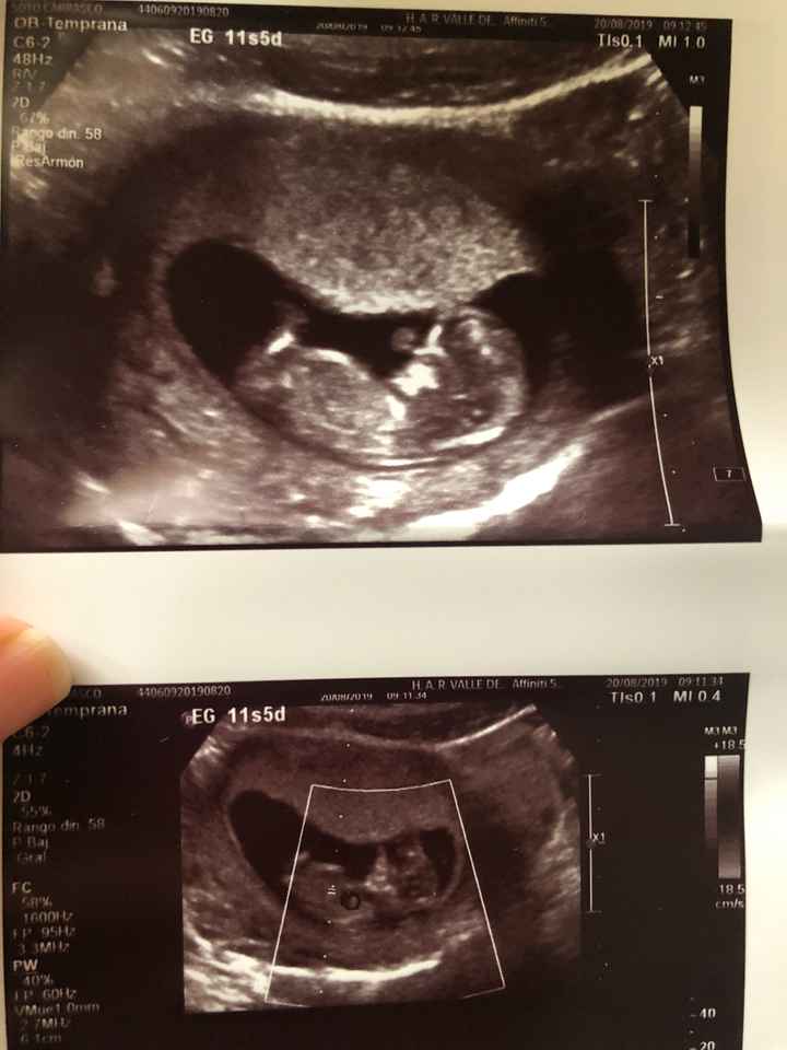 Tubérculo genital: niña - 1