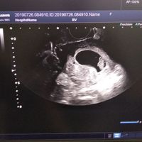 Ayuda con método ramzi: niño o niña? - 1