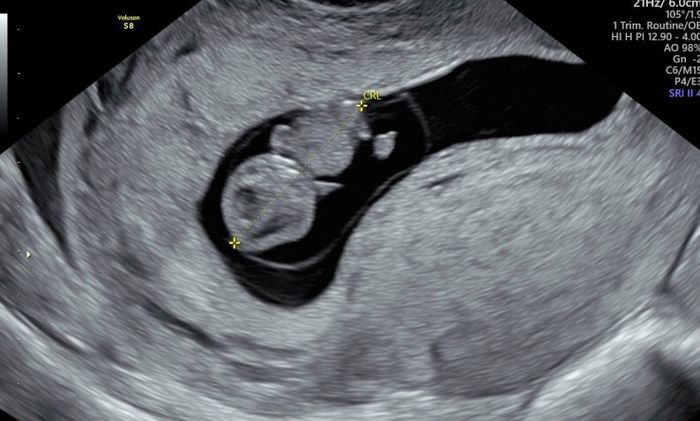 Ayuda con método ramzi: niño o niña? - 1